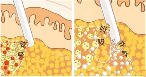 抽脂手術(shù)抽脂方式動(dòng)畫(huà)演示圖