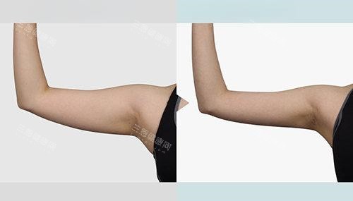 蚌埠三院整形美容中心抽脂靠譜嗎？真實(shí)體驗(yàn)分享，術(shù)前術(shù)后對(duì)比一目了然！