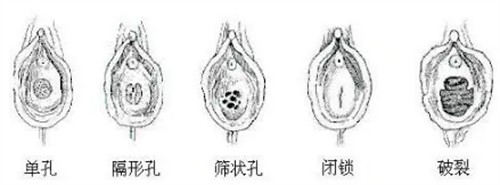 不同形狀的處女膜