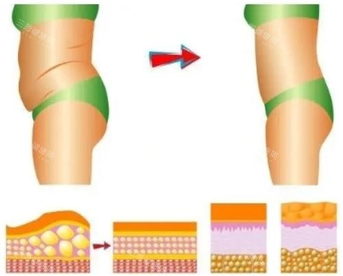吸脂過(guò)程前后示意圖