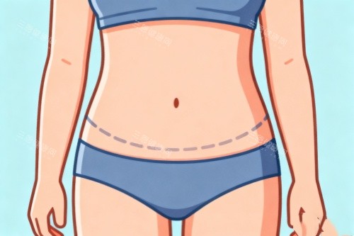 腹部吸脂卡通圖一覽