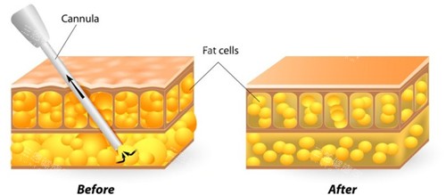 吸脂前后對(duì)比圖示