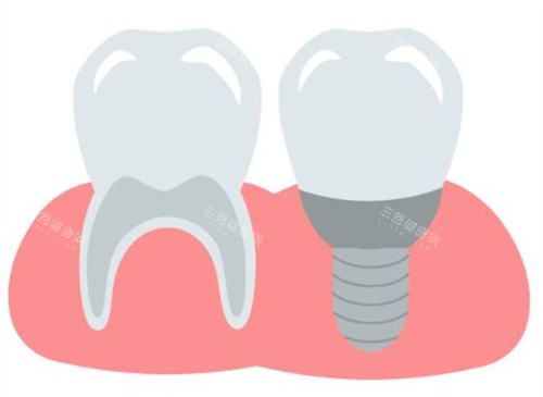 種植牙和牙齒圖