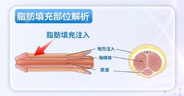 脂肪增大增粗照片