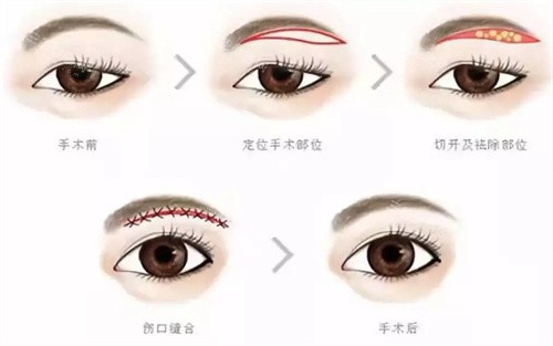 提眉手術(shù)步驟