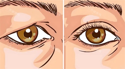 提眉前后變化有哪些
