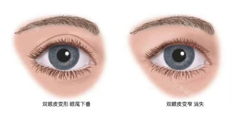 什么情況下要提眉