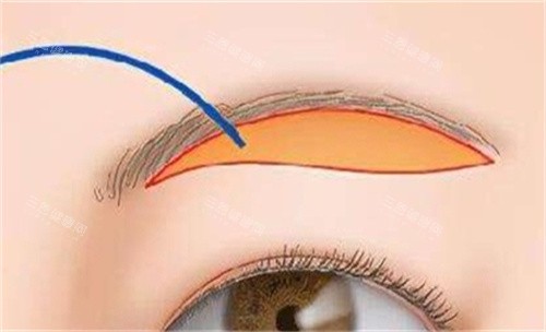 提眉手術(shù)的切口部位