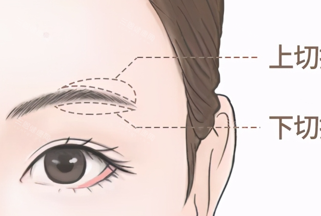 提眉上下切口示意圖