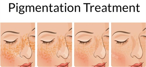 激光祛斑前后皮膚對(duì)比