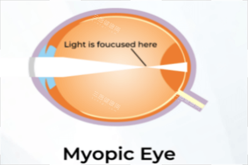 近視示意圖
