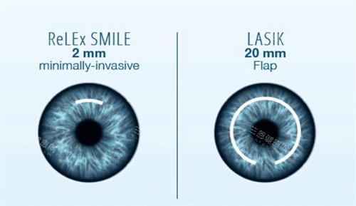 全飛秒和半飛秒手術對比圖