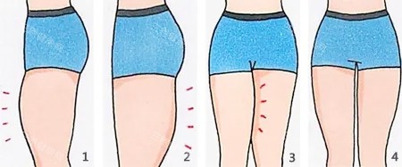 大腿吸脂卡通圖