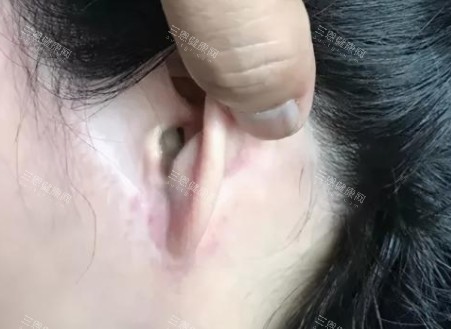 拉皮手術(shù)疤痕圖