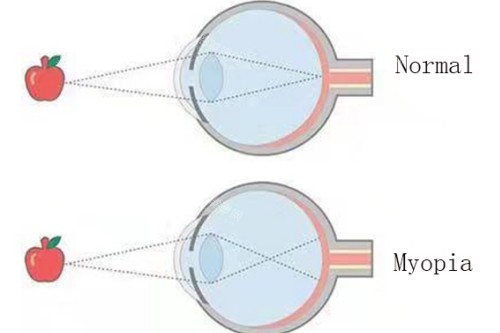 近視眼與正常眼對比