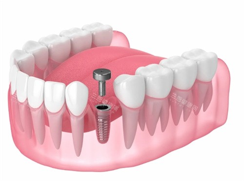 種植牙愈合基臺(tái)透視動(dòng)畫(huà)