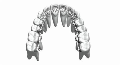 牙齒矯正舌側(cè)矯正牙套概念透視圖