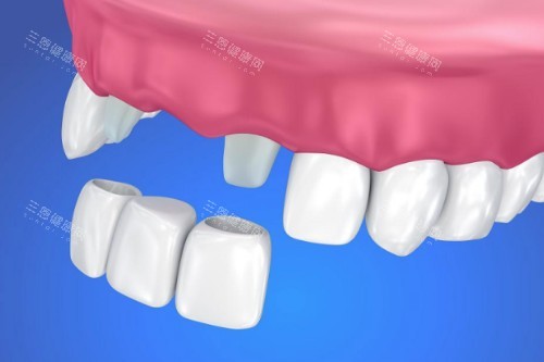 鑲牙具體安裝圖