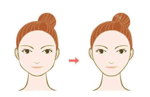 面部輪廓整形卡通圖