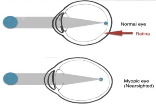 正常眼與近視眼對比