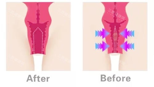 陰道緊縮對(duì)比圖