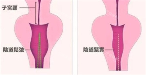 生物束帶緊縮術(shù)對(duì)比