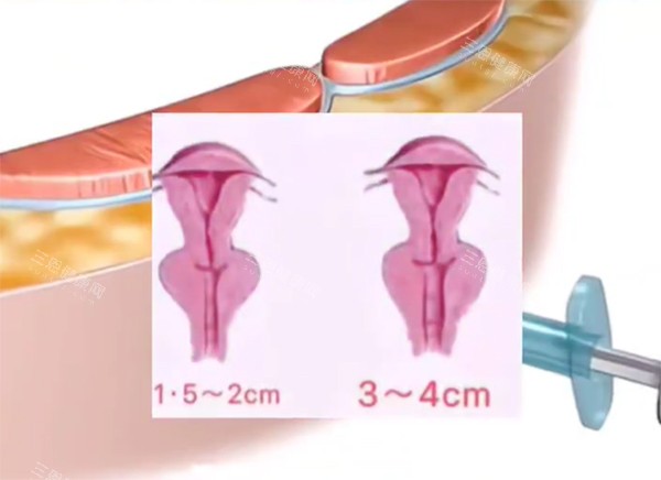 緊縮針對(duì)比動(dòng)畫**