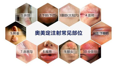 奧美定注射危害有哪些