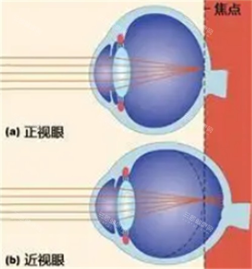 正常眼睛和近視眼鏡的不同