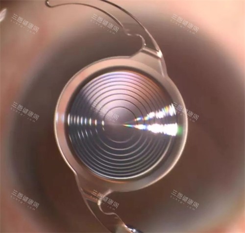白內(nèi)障竟晶體示意圖