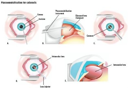 超聲乳化白內(nèi)障吸除術(shù)過程