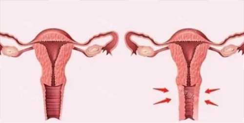 3D生物束帶緊縮術對比圖