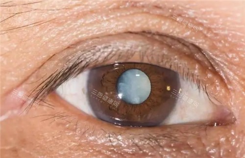 白內(nèi)障眼球圖