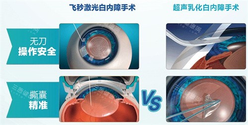 飛秒激光白內(nèi)障手術(shù)和超聲乳化白內(nèi)障手術(shù)區(qū)別