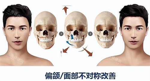 正頜手術原理與對比展示動畫圖