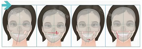 正頜手術手術步驟展示動畫圖