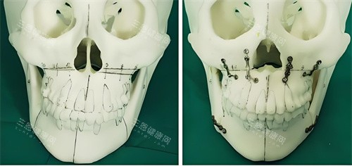 正頜手術手術原理展示圖