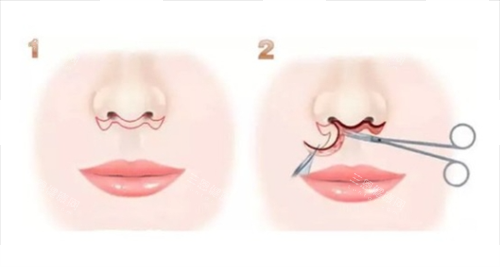 人中縮短術(shù)步驟過程