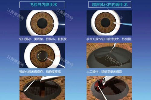 飛秒白內(nèi)障和超聲乳化白內(nèi)障