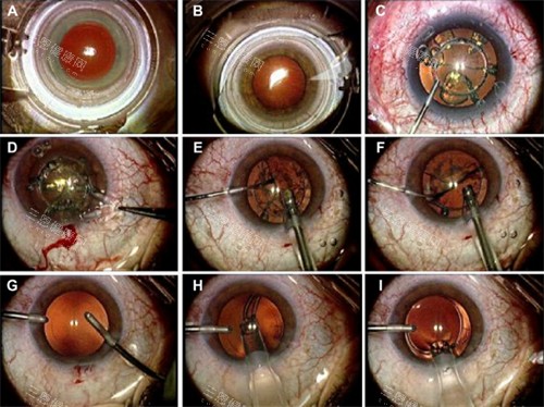 全飛秒手術(shù)過(guò)程圖解
