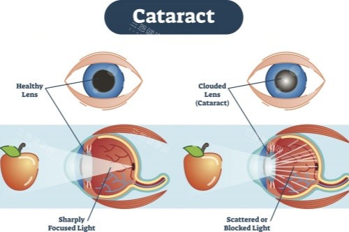 正常眼睛與白內(nèi)障眼睛視物對(duì)比圖
