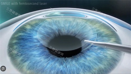 全飛秒手術(shù)演示圖