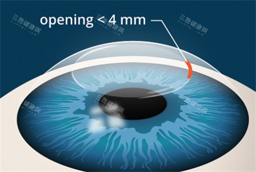 全飛秒手術(shù)動(dòng)畫(huà)