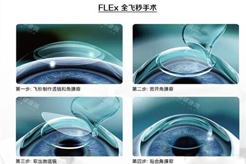 全飛秒手術(shù)過(guò)程示意圖