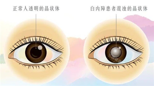 白內(nèi)障和正常眼球的對(duì)比圖