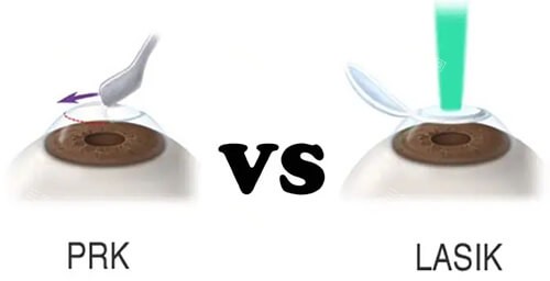 PRK近視手術(shù)對(duì)比LASIK近視手術(shù)漫畫圖