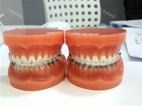 牙齒矯正牙套模型