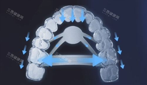 正雅隱形矯正s11牙齒位移變化