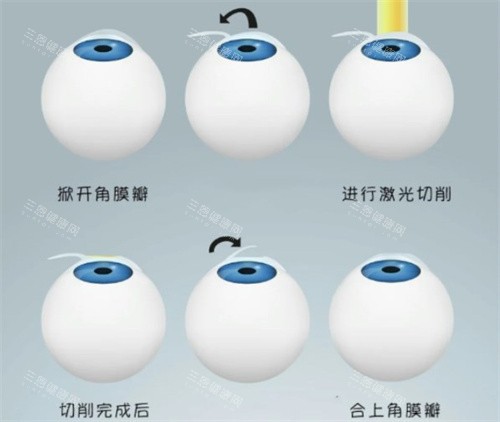 半飛秒手術(shù)過程