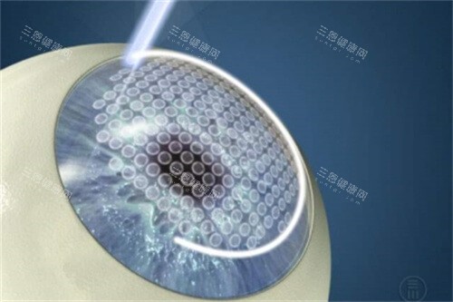 半飛秒激光手術(shù)過程